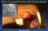 Early First-in-Human Use Experiences with the Apica Transapical Access and Closure System