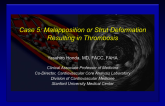 Case 5: Malapposition or Strut Deformation Resulting in Thrombosis