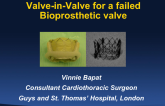 Valve-in-Valve for Failed Bioprosthetic Valves