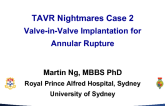Case 2: Valve-in-Valve Implantation for Annular Rupture
