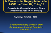 Paravalvular Regurgitation as a Strong Predictor of Post-TAVR Mortality