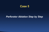 Case 5: Perforator Ablation Step by Step