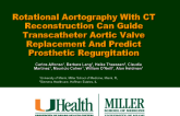 Rotational Aortography With CT Reconstruction Can Guide Transcatheter Aortic Valve Replacement And Predict Prosthetic Regurgitation