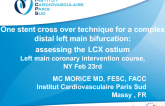 Case 4: One-Stent Crossover Technique for a Complex Distal Left Main Bifurcation: Assessing the LCX Ostium