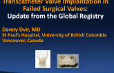 Update from the Global Valve-in-Valve TAVR Registry