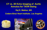 Comparison of CT and 3-D TEE for THV Sizing and Prevention of PVL