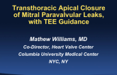 Transthoracic Apical Closure of Mitral Paravalvular Leaks, with TEE guidance (Including Case Presentations)