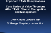 Case Series of Valve Thrombus After TAVR: Clinical Recognition and Management