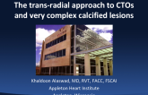 The trans-radial approach to CTOs and very complex calcified lesions