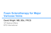 Foam Sclerotherapy for Major Varicose Veins