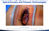 Landscape Highlights of Transcutaneous LV Apical Access and Closure Technologies