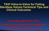 TAVI Valve-in-Valve for Failing Stentless Valves: Technical Tips and Clinical Outcomes