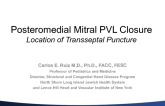 For Posteromedial Mitral Paravalvular Leak Closure