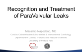 Recognition and Treatment of Paravalvular AR