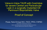 Case #3 - Valve-in-Valve TAVR for Paravalvular Leak: Proof of Concept