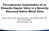 Case Vignette: Treatment of Calcific Mitral Stenosis with a Balloon Expandable Transcatheter Bioprostheses