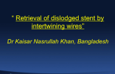 Case #2: Retrieval of a Dislodged Stent by Intertwining Wires