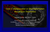 Case V: Malapposition or Strut Deformation Resulting in Thrombosis