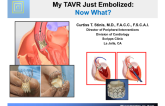 My TAVR Just Embolized: Now What?