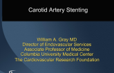 Evaluation and Management of Carotid Arterial Disease