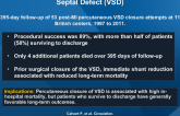 Percutaneous Closure of Post-MI Ventricular Septal Defect (VSD)