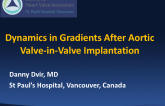 Dynamics in Gradients after Aortic Valve-in-Valve Implantation: An Argument for Anticoagulation Treatment