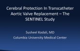 Introduction to the US FDA-Approved Sentinel TAVR Safety and Efficacy Study