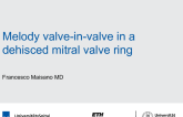 Successful First-in-man Melody Transcatheter Valve Implant in a Dehisced Mitral Annuloplasty Ring