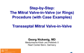 Transseptal Mitral Valve-in-Valve