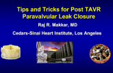 Paravalvular Leak Closure after TAVR: Indications and Technical Insights
