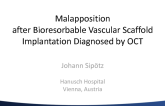 Case #2: Malapposition After Bioresorbable Vascular Scaffold Implantation Diagnosed by IVUS/OCT