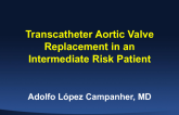 Case Presentation #2: Aortic Stenosis in an Intermediate-Risk Patient