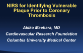 NIRS for Identifying Vulnerable Plaque Prior to Coronary Thrombosis
