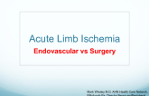 Managing Acute Limb Ischemia: Which Patients Get Endovascular and When Is Bypass Preferred?