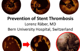 Prevention of Stent Thrombosis: Devices, Pharmacology, Technique, Patients, and More