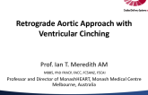 Retrograde Aortic Approach with Ventricular Cinching (Guided Delivery Systems)