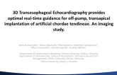 3D Transesophageal Echocardiography provides optimal real-time guidance for off-pump, transapical implantation of artificial chordae tendineae_ An imaging study_