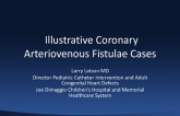 An Illustrative Coronary Arteriovenous Fistulae Case