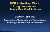 DCB Use in the Real World II: DCB for Long and Highly Calcified Vessels