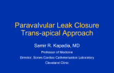 Case #2: Mitral Paravalvular Leak Closure: Transapical Approach