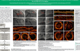 Delayed coverage of drug eluting stents after interventional revascularization of chronic total occlusions assessed by optical coherence tomography: the ALSTER-OCT-CTO registry