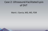 Ultrasound Facilitated Lysis of DVT