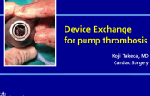Device Exchange for pump thrombosis