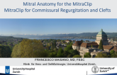 MitraClip for Commissural Regurgitation and Clefts