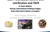 Case Presentation: Severe LVOT Calcification and TAVR