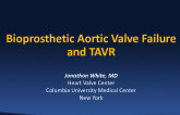 Case Presentation: Bioprosthetic Aortic Valve Failure and TAVR