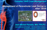 Case Presentation: Management of Paravalvular Leaks During or After TAVR