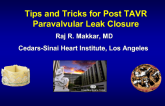 Step by Step: Aortic Paravalvular Leak Closure
