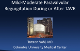 Case Presentation: Mild-Moderate Paravalvular Regurgitation During/After TAVR