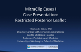 Case Presentation: Restricted Posterior Leaflet